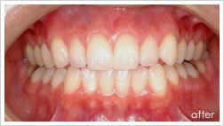 おおしま歯科ではホワイトニングでオパールエッセンスを使用しています。